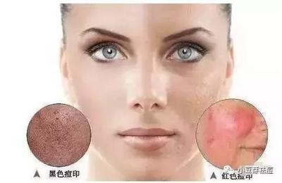 脸上黑色痘印怎么去除