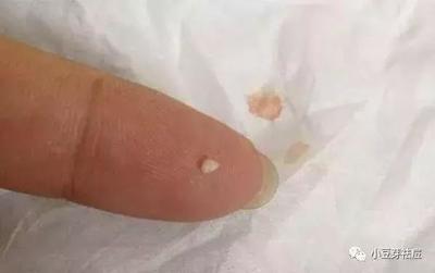 痘痘头变白
