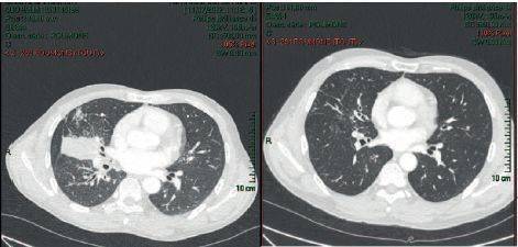 肺腺癌治疗花多少钱