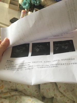 双侧卵巢多囊会怀孕吗