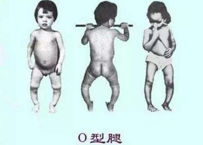 宝宝佝偻病怎么治疗