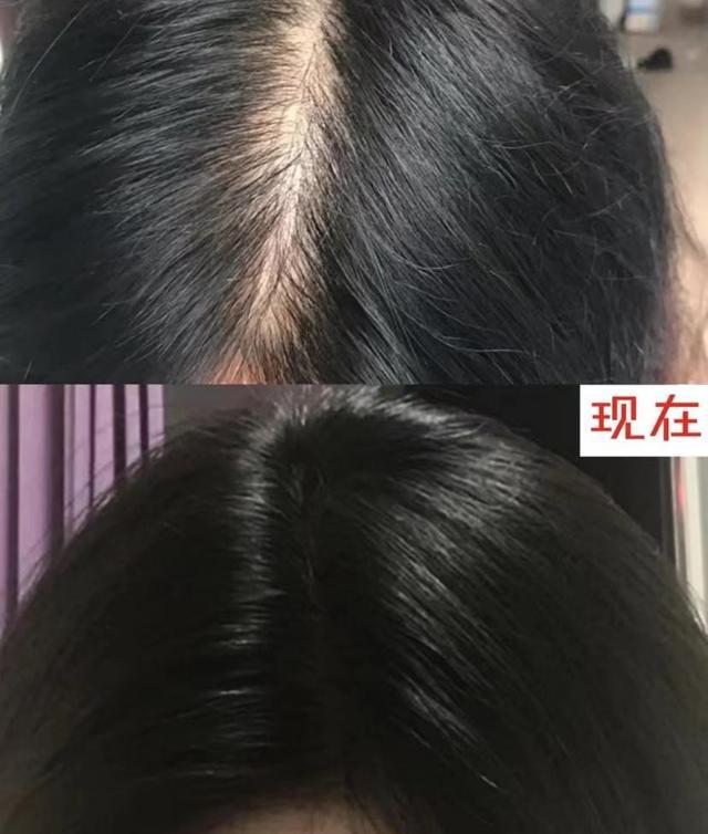 一个月头发能长多少厘米