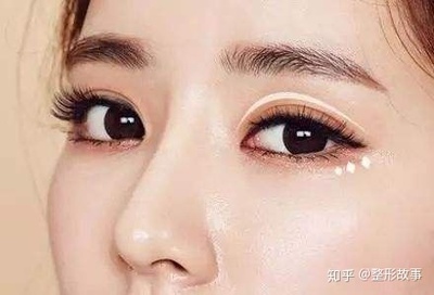 埋线双眼皮拆线疼吗