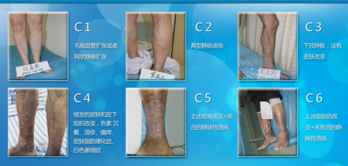 静脉曲张前期怎么治疗