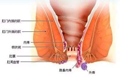 内痔二期怎么治疗