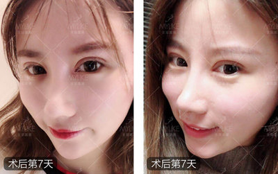 脸上总是有小痘痘