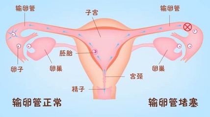 单侧输卵管怀孕的技巧