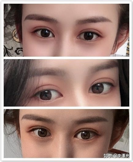 哪做双眼皮好