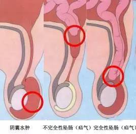 一侧睾丸疼痛是怎么回事