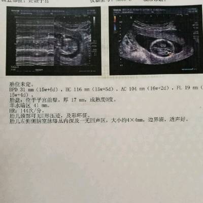 胎儿四个月有多大