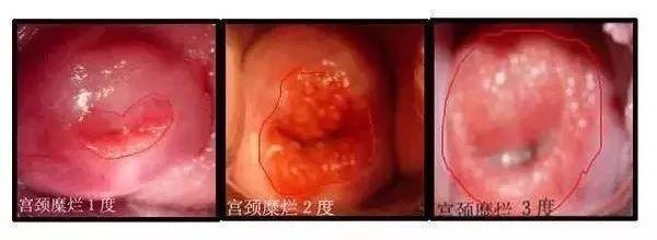 宫颈糜烂两度怎么治疗