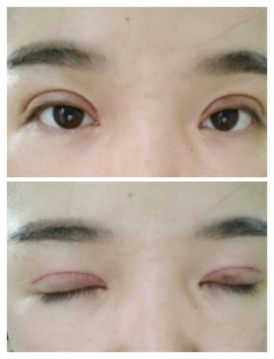 双眼皮结痂多久掉