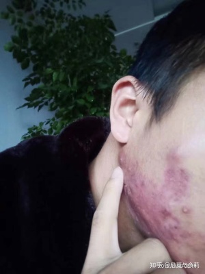 腮部反复长痘痘