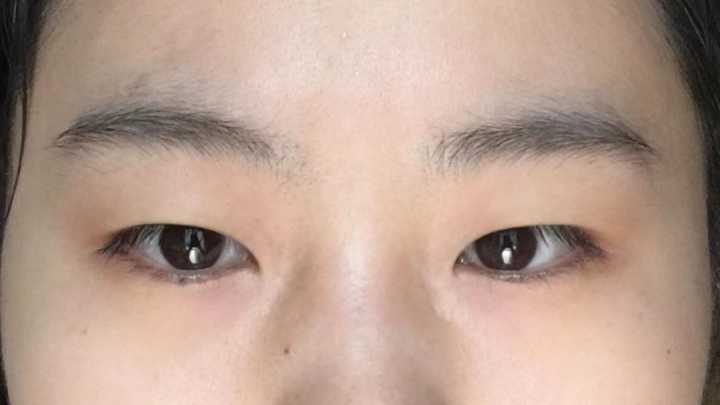压 双眼皮
