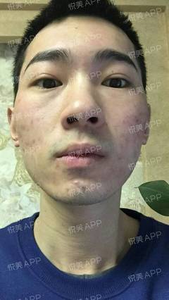 祛痘痘痘印的app软件