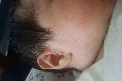月子里的宝宝湿疹图片