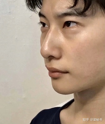 男生隆鼻要多少钱