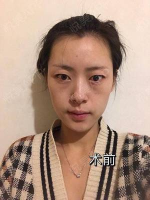 疤痕恢复期是多久