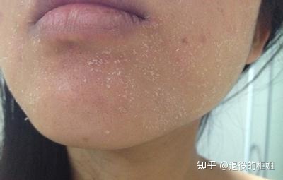 红血丝皮肤用什么面膜