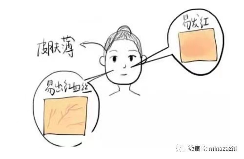 痘痘肌可以去角质