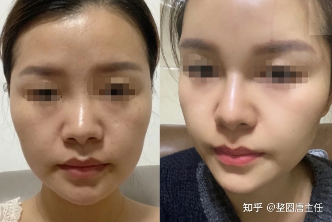 打玻尿酸的效果