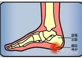 足底筋膜炎怎么治疗