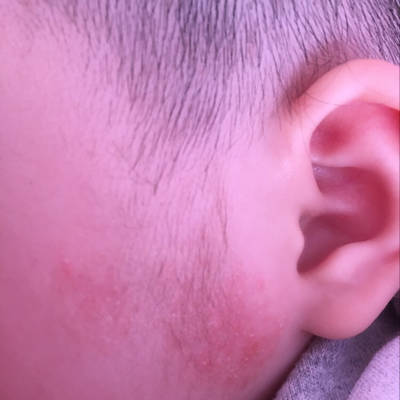 两鬓总是长痘痘是什么原因