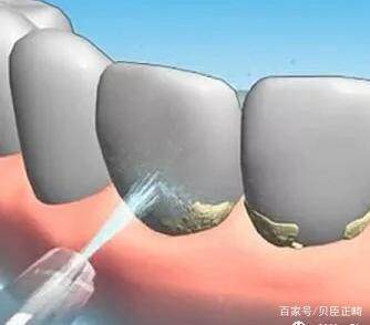 多长时间洗一次牙比较好