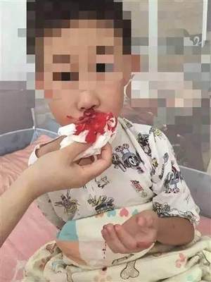 两岁宝宝流鼻血怎么办