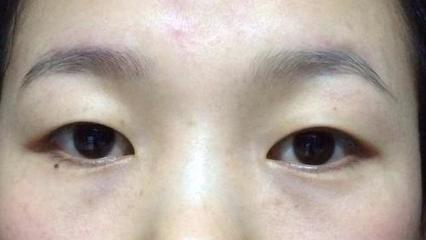 做双眼皮老了会怎样