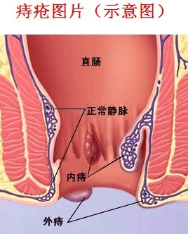 痔疮犯了怎么治疗最好