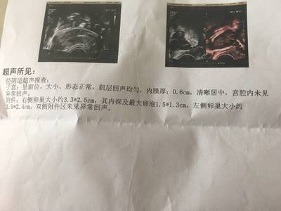 多囊怀孕