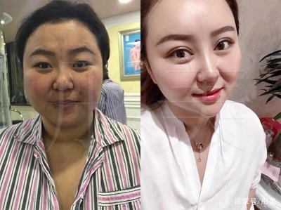 割双眼皮会影响运势吗
