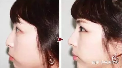 注射隆鼻如何取出