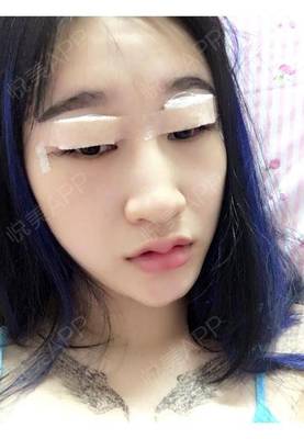 小眼角充血是怎么回事