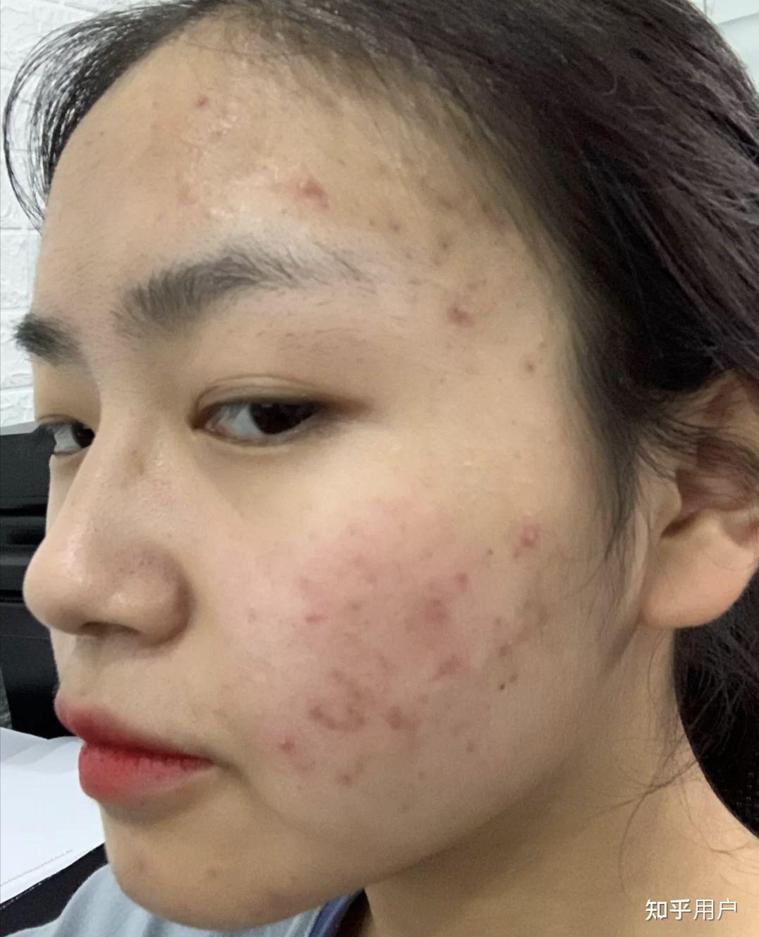 如何把痘痘皮肤养好