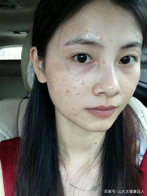 脸上长痘痘吃什么内调