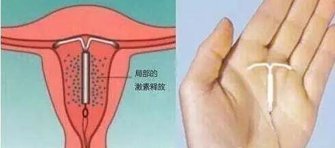 上环久了会影响怀孕吗