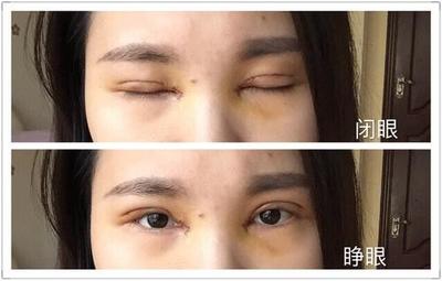 割双眼皮几天可以上班