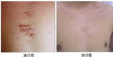 疤痕痘痘怎么去除偏方