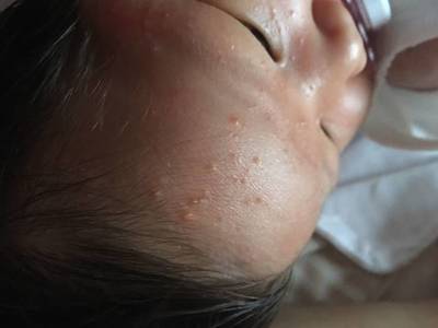 发出来好多痘痘怎么回事呢