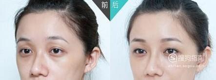 玻尿酸填充多久恢复自然