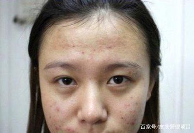 痘痘有周期吗