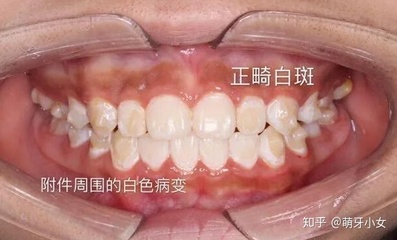 得了口腔白斑怎么治疗