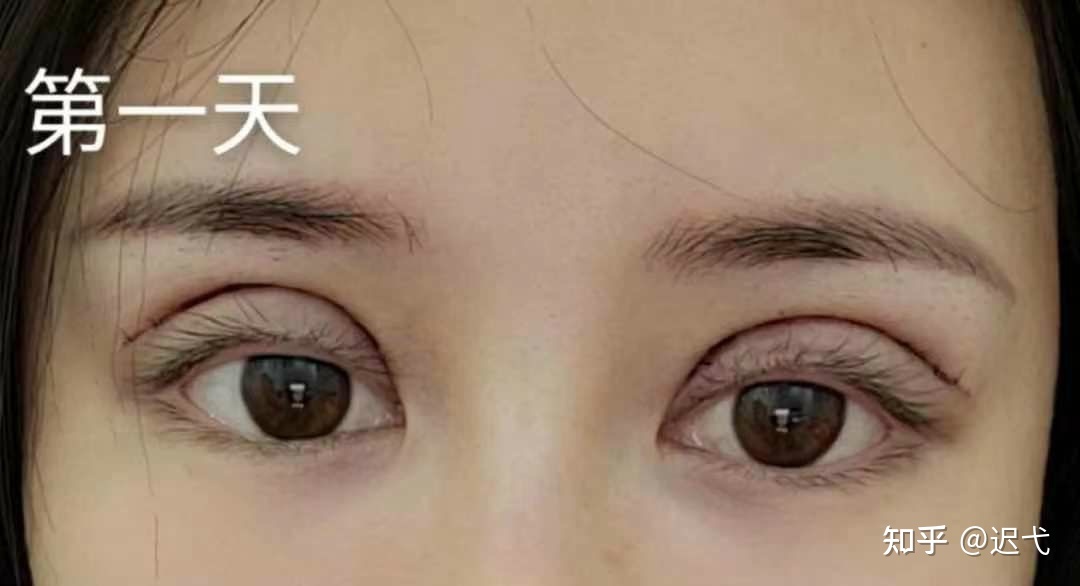 做完双眼皮水肿的原因
