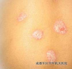 儿童皮疹怎么治疗