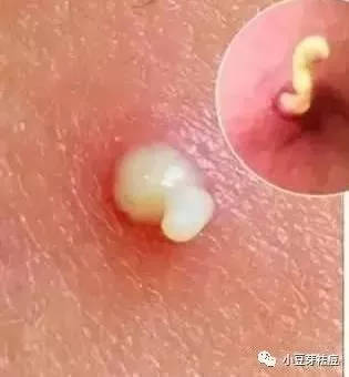 挤痘痘挤出白色的