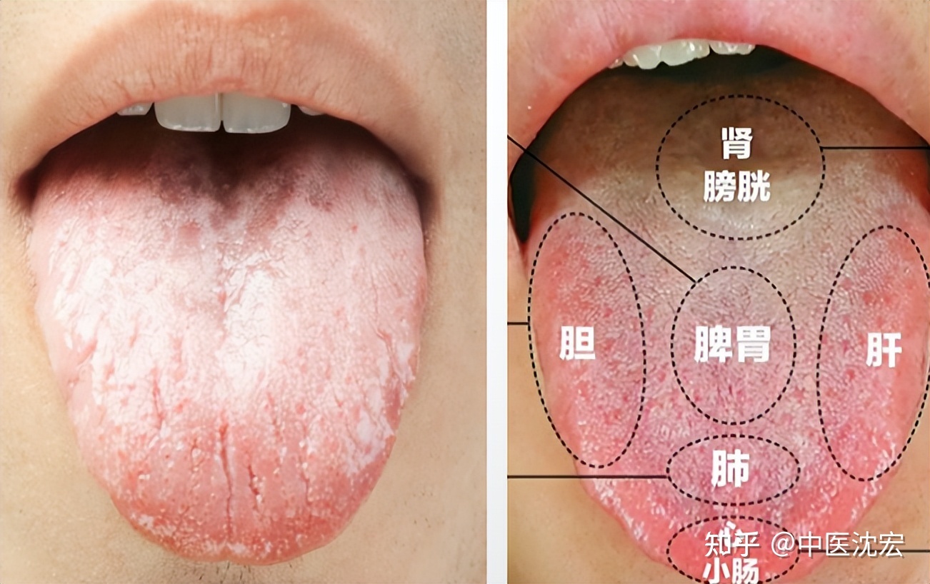 舌苔白又厚是怎么回事