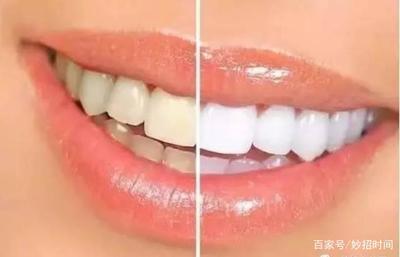 吸烟牙黄洗牙能变白吗