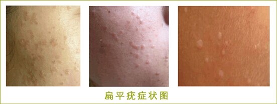 线状疣怎么治疗